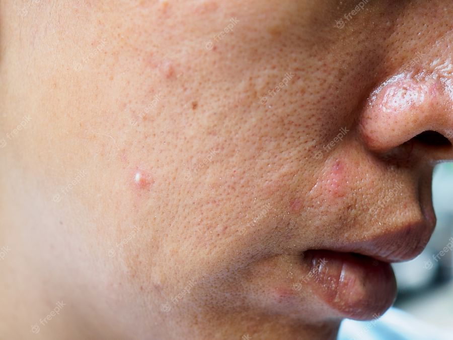 Close-up view of acne on skin