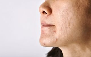 What Causes Blackheads to Enlarge?
