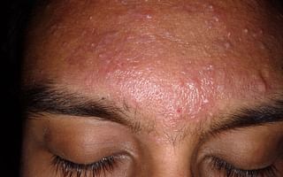What is the typical timeline for acne treatment with a dermatologist?